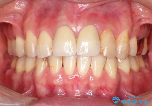 変色した前歯をセラミックできれいに レイヤリングセラミックの治療後