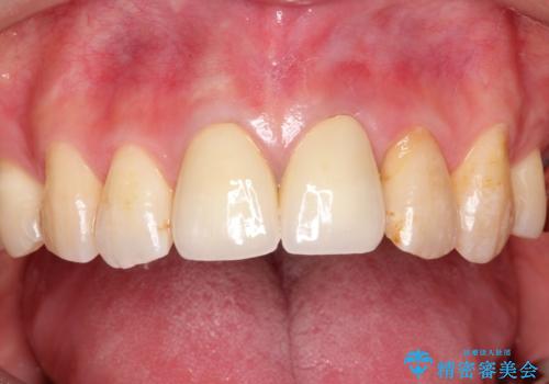 変色した前歯をセラミックできれいに レイヤリングセラミックの治療後