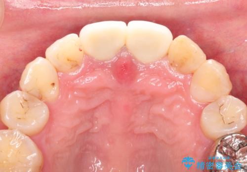 変色した前歯をセラミックできれいに レイヤリングセラミックの治療後