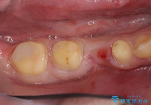 オールセラミッククラウン　歯肉より深い虫歯の治療の治療中