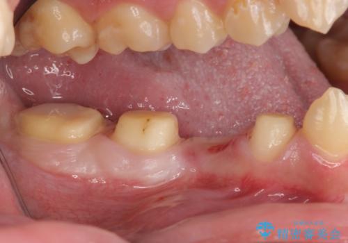オールセラミッククラウン　歯肉より深い虫歯の治療の治療中