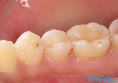 虫歯の治療 セラミックの詰め物で綺麗にの治療後