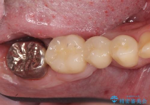 オールセラミッククラウン　歯肉より深い虫歯の治療の治療後