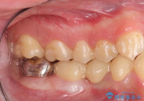 オールセラミッククラウン　歯肉より深い虫歯の治療の治療後