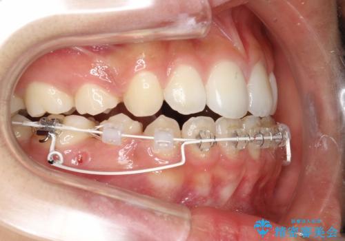 ハーフリンガル　半分裏側矯正による上下前突の抜歯矯正治療