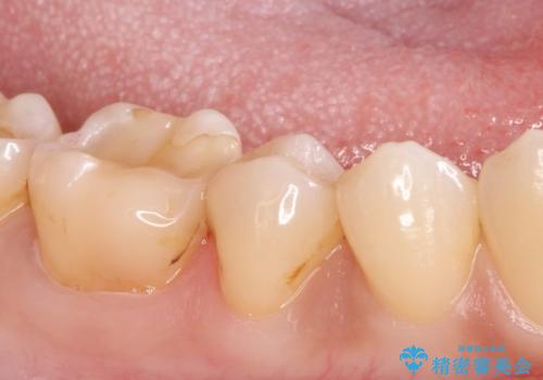 虫歯の治療 セラミックの詰め物で綺麗にの治療後