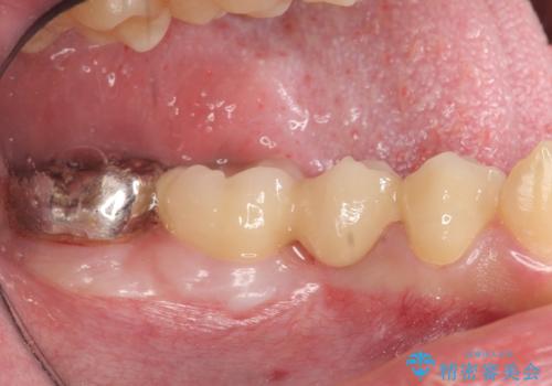 オールセラミッククラウン　歯肉より深い虫歯の治療