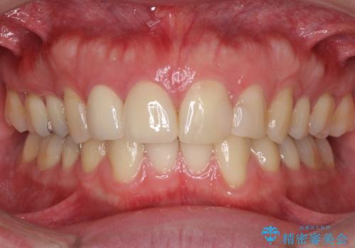 前歯のつめものが汚い セラミックできれいにの治療後