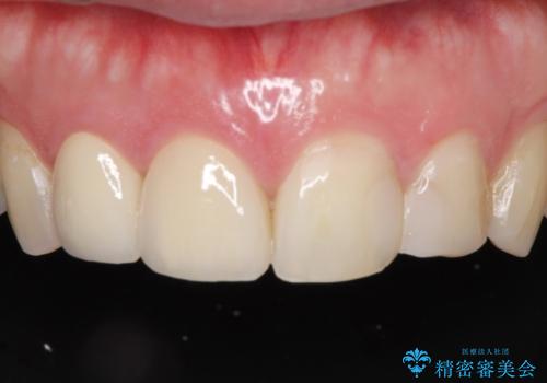 前歯のつめものが汚い セラミックできれいにの症例 治療後