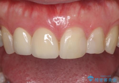 前歯のつめものが汚い セラミックできれいにの治療後