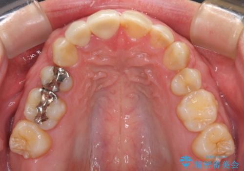 前歯のつめものが汚い セラミックできれいにの治療後