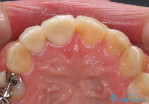 前歯のつめものが汚い セラミックできれいにの治療後