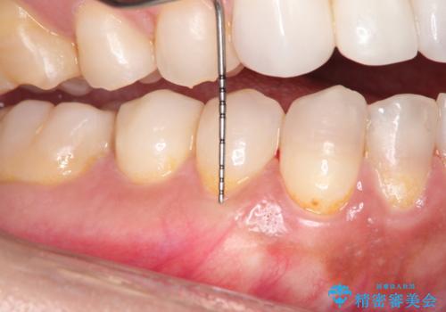 下がってしまった歯肉を元に戻したいが、自分の歯ぐきを移植するのは気が進まない : バイオマテリアルを応用した歯肉退縮への手術的対応の治療後