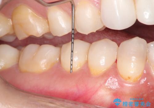 下がってしまった歯肉を元に戻したいが、自分の歯ぐきを移植するのは気が進まない : バイオマテリアルを応用した歯肉退縮への手術的対応の治療後