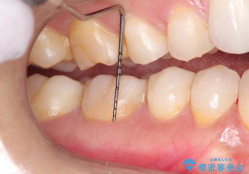 下がってしまった歯肉を元に戻したいが、自分の歯ぐきを移植するのは気が進まない : バイオマテリアルを応用した歯肉退縮への手術的対応の治療後