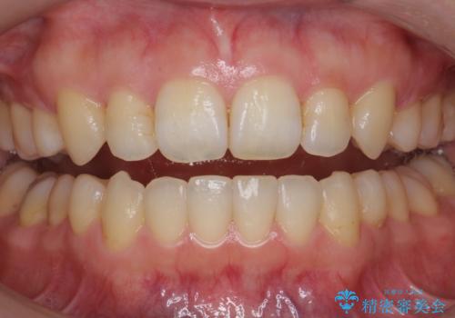黄ばんだ歯をホワイトニングできれいに。の治療前