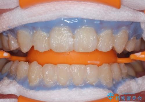 黄ばんだ歯をホワイトニングできれいに。の治療中