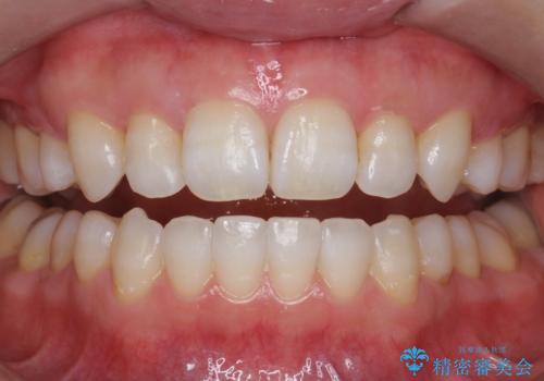 黄ばんだ歯をホワイトニングできれいに。の治療後