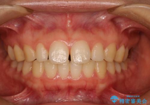 Invisalign インビザライン lite ライト 隙っ歯の改善の症例 治療前