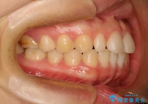 Invisalign インビザライン lite ライト 隙っ歯の改善の治療前