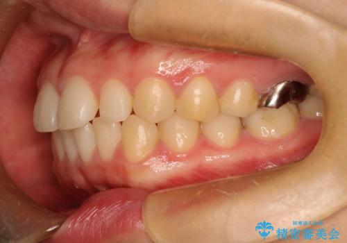 Invisalign インビザライン lite ライト 隙っ歯の改善の治療前