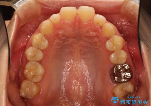 Invisalign インビザライン lite ライト 隙っ歯の改善の治療前