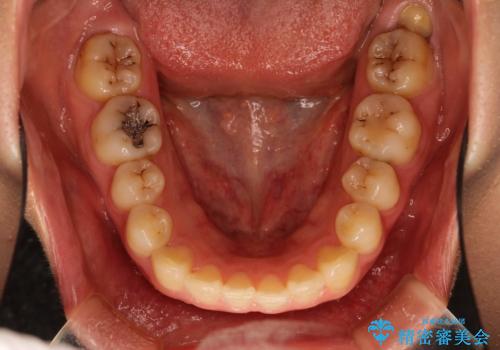 Invisalign インビザライン lite ライト 隙っ歯の改善の治療前