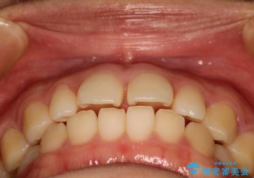 Invisalign インビザライン lite ライト 隙っ歯の改善