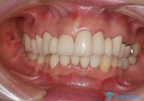 前歯をきれいに　部分矯正とオールセラミッククラウンの治療後