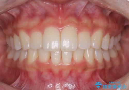 Invisalign インビザラインによる軽度なガタつきの改善