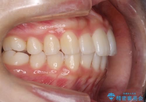 Invisalign インビザラインによる軽度なガタつきの改善の治療後