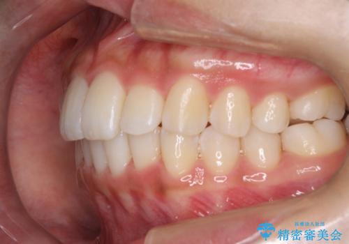 Invisalign インビザラインによる軽度なガタつきの改善の治療後