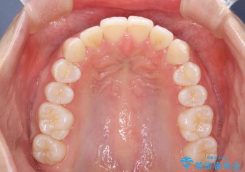 Invisalign インビザラインによる軽度なガタつきの改善の症例 治療後