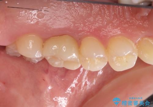 金属の奥歯　→　白い奥歯　根管治療からのやり直しの治療後