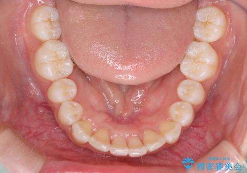 Invisalign インビザラインによる軽度なガタつきの改善の治療後