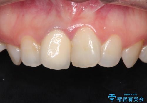 前歯の治療。再根管治療~セラミッククラウンの治療前