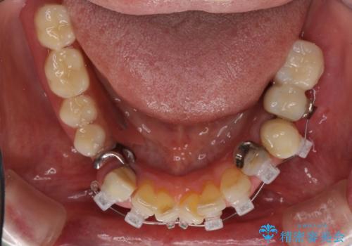 インプラントと入れ歯による全顎補綴治療の治療中