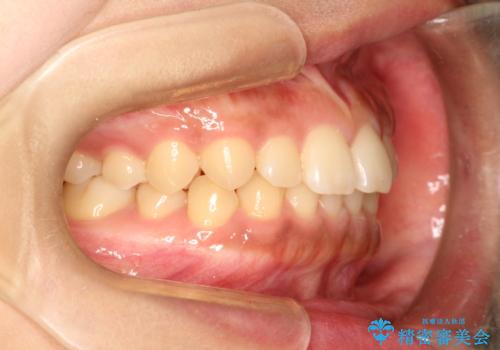 前歯の隙間を閉じたい。インビザラインによる治療の治療前