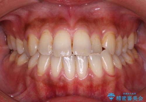 Invisalign インビザライン によるガタつき、受け口傾向の改善の治療前