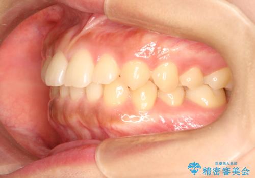 前歯の隙間を閉じたい。インビザラインによる治療の治療前