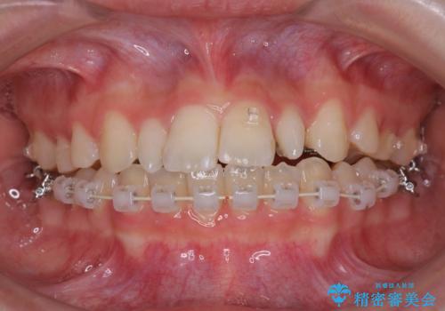 歯の形態修正も含めた矯正治療&セラミック治療の治療中