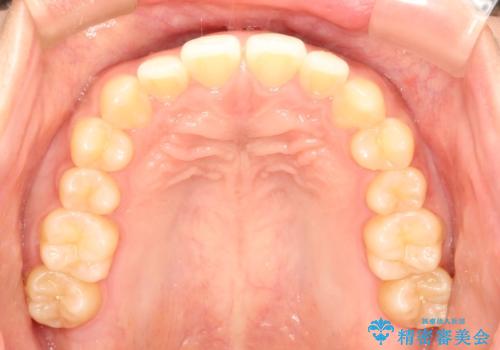 前歯の隙間を閉じたい。インビザラインによる治療の治療前