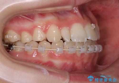 歯の形態修正も含めた矯正治療&セラミック治療の治療中