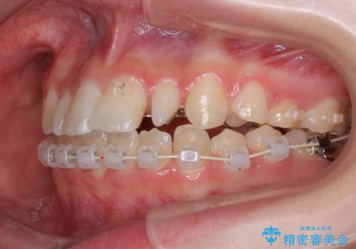 歯の形態修正も含めた矯正治療&セラミック治療の治療中