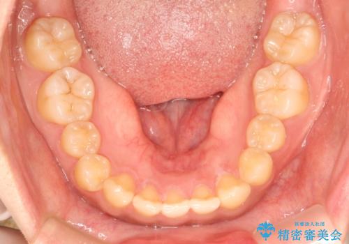 前歯の隙間を閉じたい。インビザラインによる治療の治療前