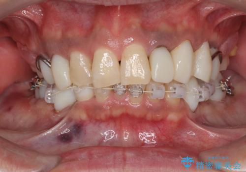 奥歯で物を噛めるようにしたい 入れ歯による咬合回復の治療中