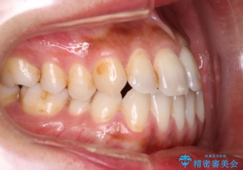 Invisalign インビザライン によるガタつき、受け口傾向の改善の治療前