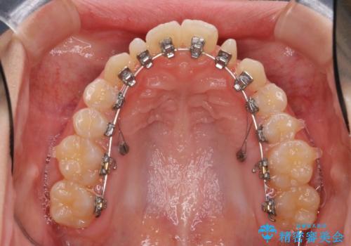 歯の形態修正も含めた矯正治療&セラミック治療の治療中