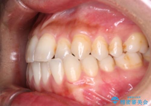 Invisalign インビザライン によるガタつき、受け口傾向の改善の症例 治療前