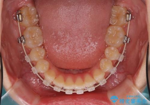 歯の形態修正も含めた矯正治療&セラミック治療の治療中